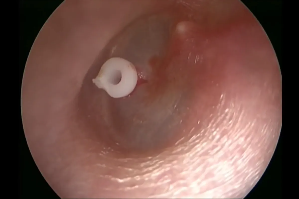 Tubo de ventilação